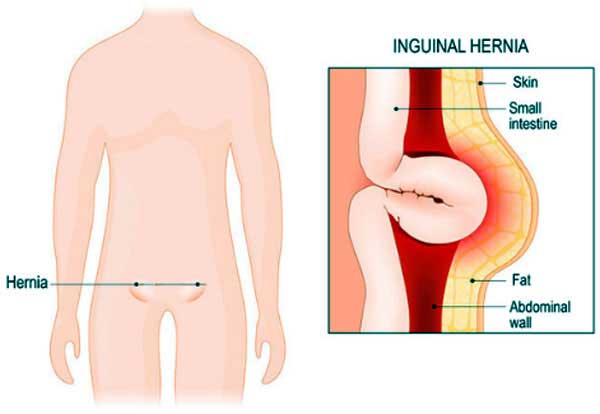 A Case of Inguinal Hernia?